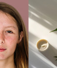 Marihuana a pleť: Môže THC spôsobovať akné, vrásky a zhoršiť stav pokožky?